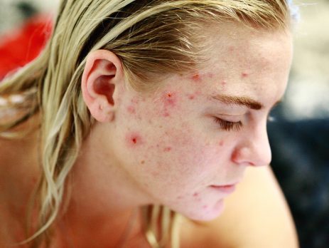 Woman with acne and sensitive skin.